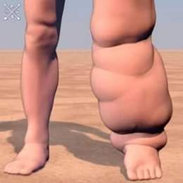 مركز الكرمه لعلاج مرض الفيل<