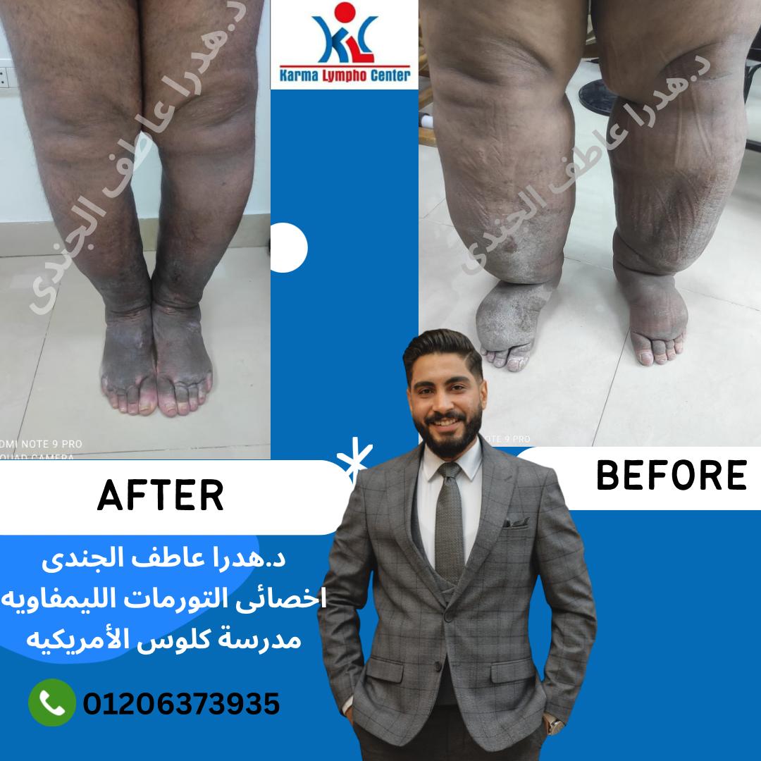 مركز الكرمه لعلاج مرض الفيل