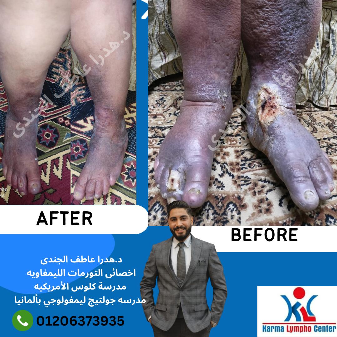 مركز الكرمه لعلاج مرض الفيل